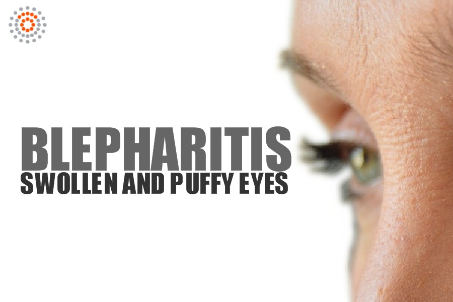 Blepharitis (Swollen Eyelids, Puffy Eyes) Symptoms, Causes and Treatments